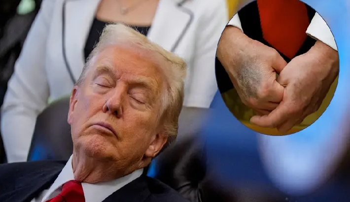 സൂപ്പര്‍സ്റ്റിഷന്‍' കാരണം ആസ്പിരിന്‍; കൈകളിലെ മുറിവുകള്‍ക്കും സ്‌കാനിനും പിന്നിലെ സത്യം തുറന്ന് ട്രംപ്