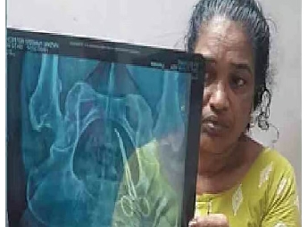 ഉഷയുടെ വയറ്റിൽ കുടുങ്ങിയ കത്രിക അഞ്ചുവർഷത്തിന് ശേഷം പുറത്തെടുത്തു; ശസ്ത്രക്...